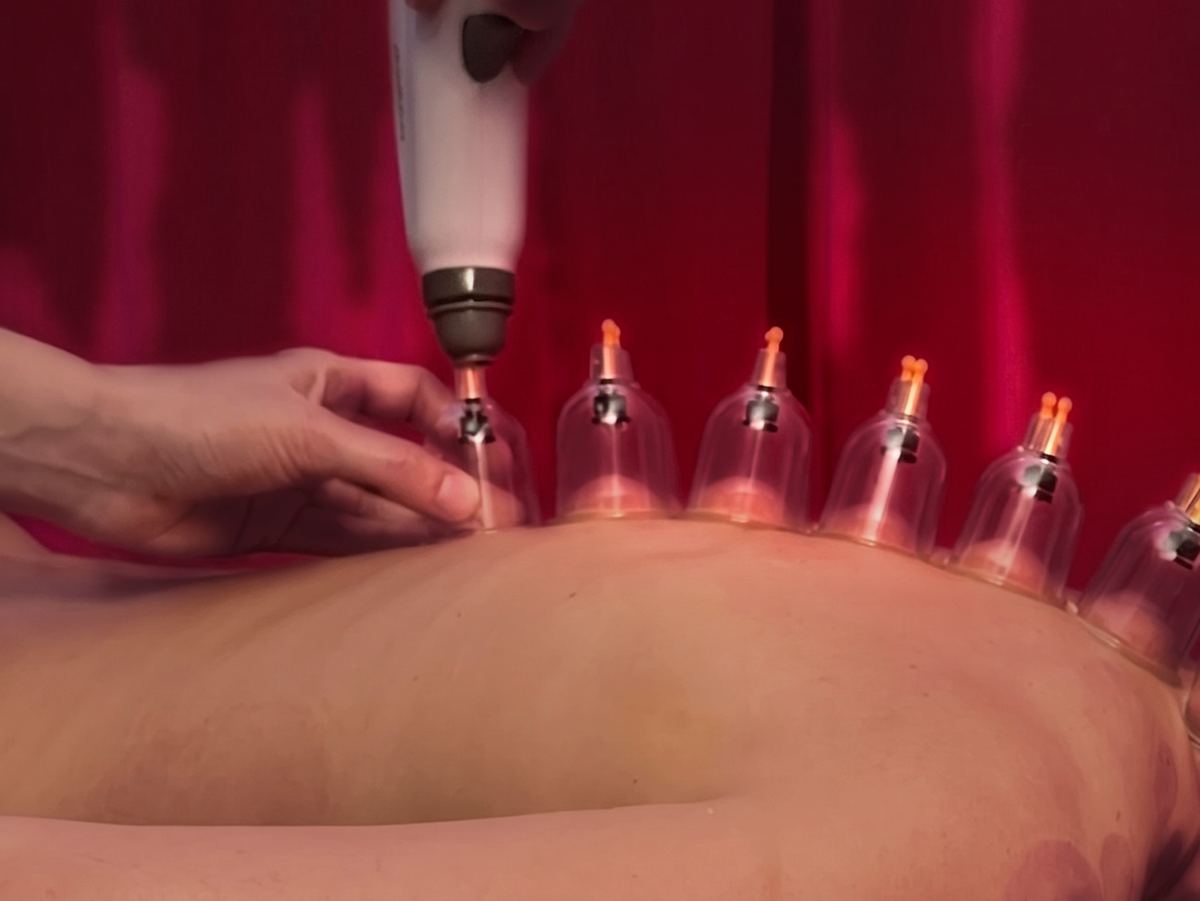 A row of cups along a client’s back, Kira setting the vacuum with a pump